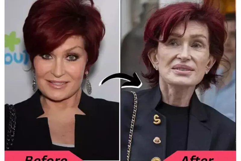 Sharon Osbourne pred in po jemanju Ozempica.