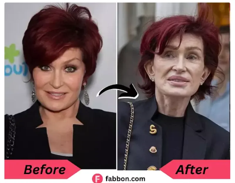 Sharon Osbourne pred in po jemanju Ozempica. 